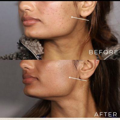 Microneedling with PRP- 3 sessions