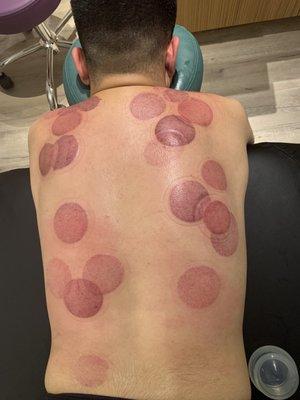 Cupping