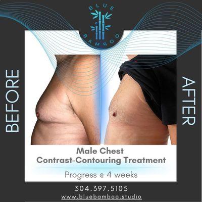 4 weeks, 2 Contrast Wave treatments, and voila! Noticeable reduction in Gynecomastia. The difference is clear and confidence-boosting.