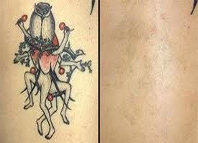 Tattoo Removal Monroeville, Pa