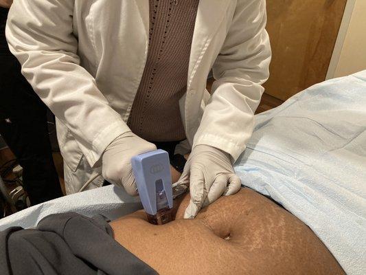 Microneedling for Stretch Mark. With Morpheus 8 technology at Everest Medspa.