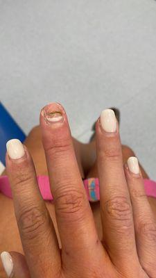 My finger after I had to have the nail removed under local anaesthetic due to fungal nail picked up from unsterilised equipment