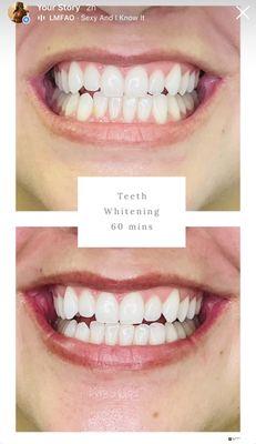 Teeth Whitening services