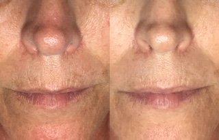 Before and After one facial and Micro-Needling treatment.