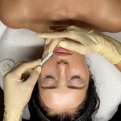 dermaplaning