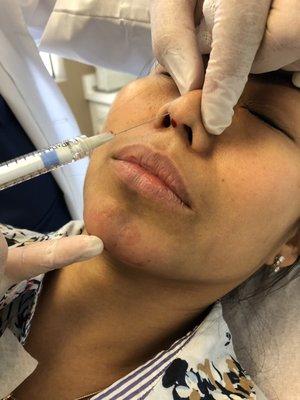 Non-Surgical Rhinoplasty with Radiesse by Dr. Haddad