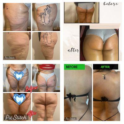 Cellulite /butt cupping /love handles