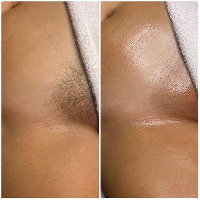 Full Brazilian sugar wax