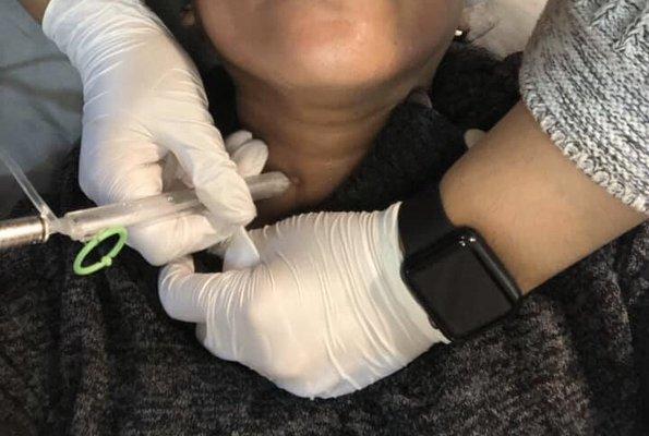 Microdermabrasion for $170! Don't forget the neck ladies