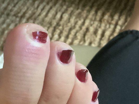 Toenails cut way too short on sides