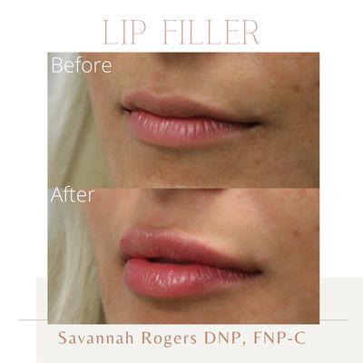 Hydrate and plump your lips with dermal filler.