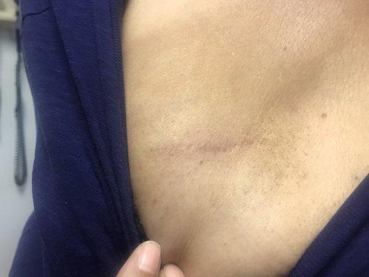 Scar after one treatment