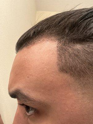 Pushed hairline back