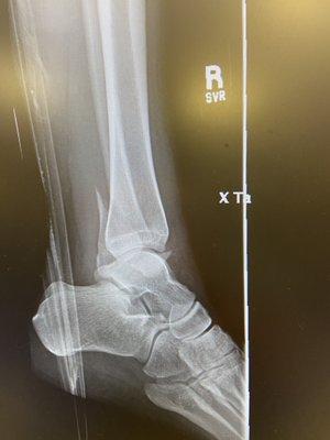 Fractured ankle