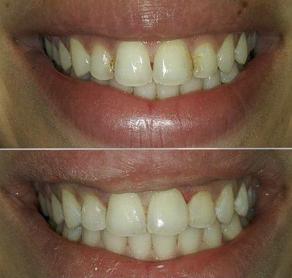 Removal of coffee stained fillings