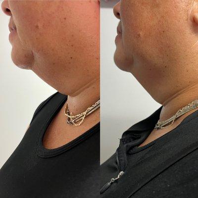 Fat reduction on Chin and skin tightening treatment