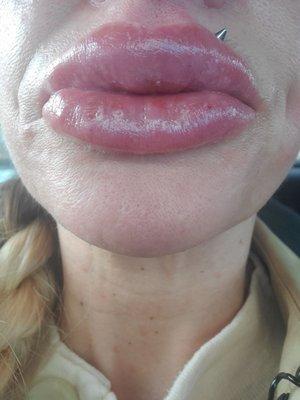 After my 5th syringe of juvederm ultra plus. Amazing transformation and results. Very satisfied.