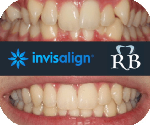 Invisalign @ Ramon Bana DDS