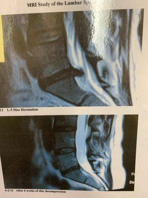 MRI before and after using the Hill Spinal Decompression Table