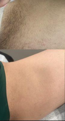 Before and after of laser hair removal for the inner thigh.