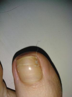 Sliced Toe nail = A lot of pain for months.