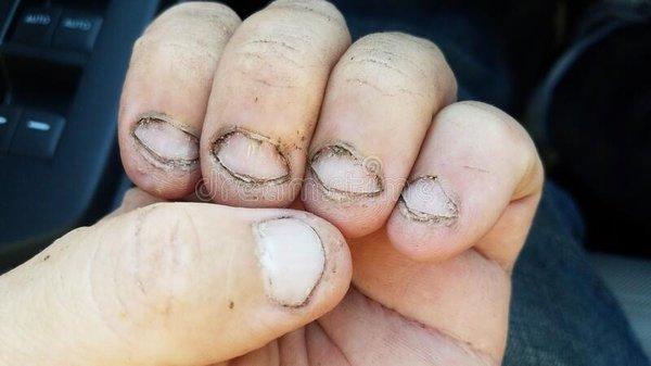 This is how the workers hand & fingernails  looked like when she touched my food without any gloves.