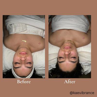 Microdermabrasion facial, before and after