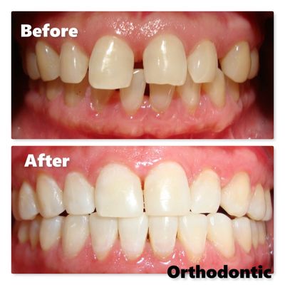 Q Smile Dental Spa offers courtesy consultation for Orthodontic, implant treatments.