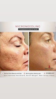 Microneedling