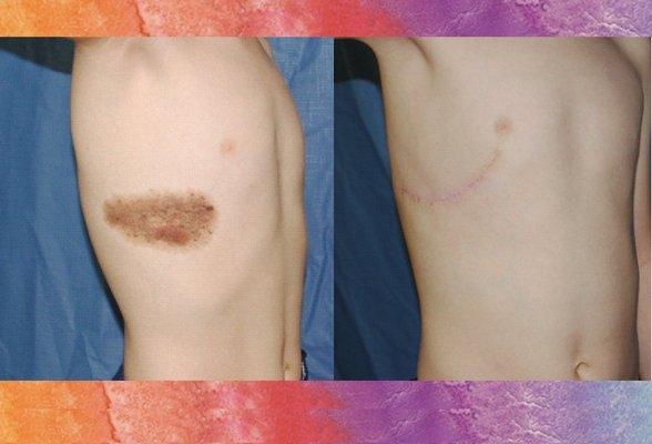 Nevus Before & After