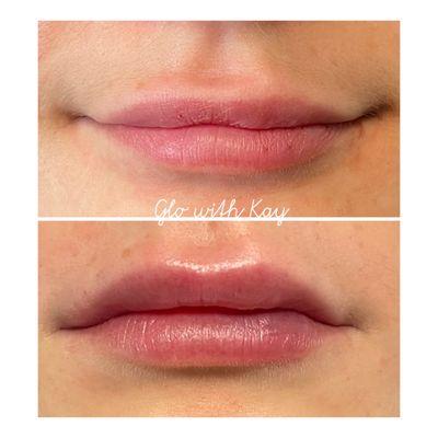 Lip enhancement