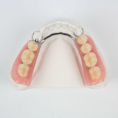 Titanium Partial Denture Finished With 3-Layer Acrylic Resin Teeth