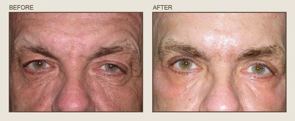 Before & After

Center for Eye & Laser Surgery- Severna Park, Maryland