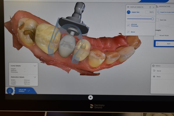 All porcelain same day crowns with digital workflow. Tooth conserving preparations with biomimetic principles.