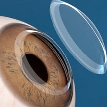 Femtosecond Laser Corneal Transplantation