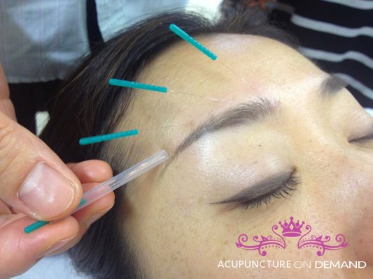 Facial Rejuvenation treatment by Acupuncture On Demand