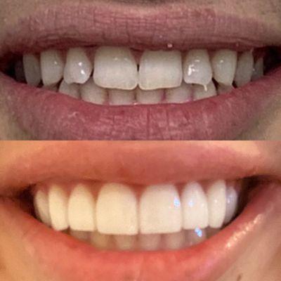 Minimal prep veneers