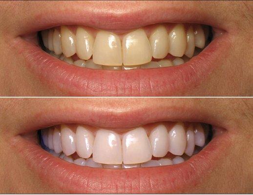 You can have a whiter brighter smile!