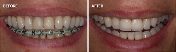 Two anteriors Emax crowns with after ortho treatment