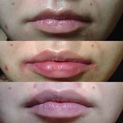 Lip filler transformation