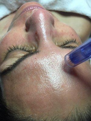 Collagen Induction