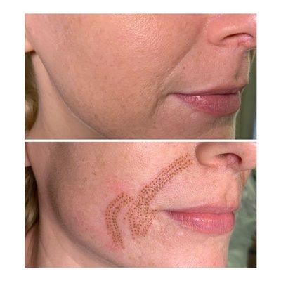 Smile line reduction, Immediately Following treatment