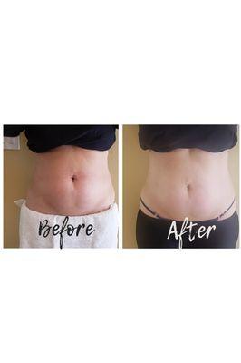 Body Contouring 1st Treatment