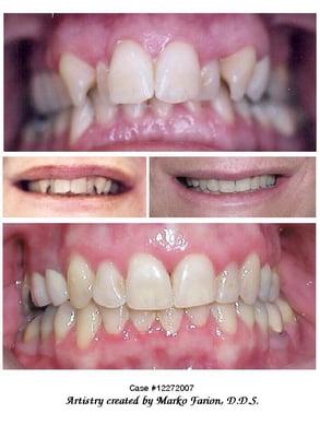 Before & After photo Orthodontics