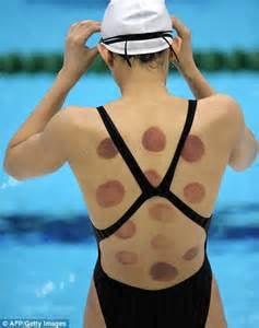 Cupping Therapy