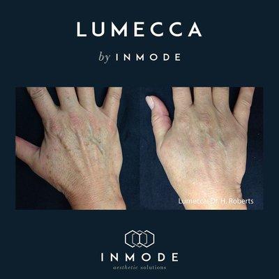 After just one use with Lumecca, patients notice significant improvements in the complexion and clarity of the skin.