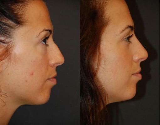 Nose Reshaping (Rhinoplasty)