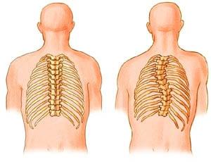 Adult Degenerative Scoliosis