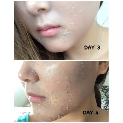 Sea herbal peel will begin to peel off from 3rd & 4th day. Stimulates new cell growth, elastin & collagen production and improves skin tone