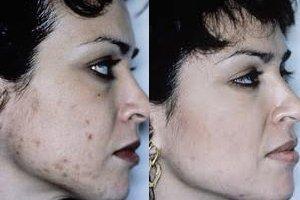 Exilis facials and skin tightening available. Before & after treatments.